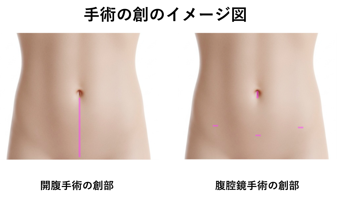 手術の創のイメージ図.png