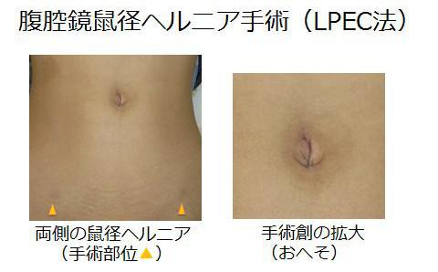 鼠径ヘルニアに対するLPEC法